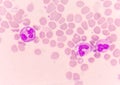 Abnormal neutrophil in blood smear.