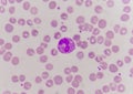 Abnormal neutrophil in blood smear.