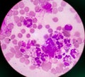 Abnormal neutrophil