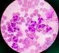 Abnormal neutrophil