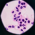 Abnormal neutrophil in pleural fluid smear