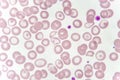 Abnormal red blood cells from anemia patient Royalty Free Stock Photo