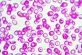 Abnormal red blood cells