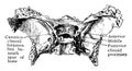 Abnormal Sphenoid Bone, vintage illustration Royalty Free Stock Photo