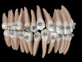 Abnormal teeth position and metal braces tretament. Medically accurate dental illustration