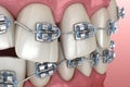 Abnormal teeth position and metal braces tretament. Medically accurate dental illustration