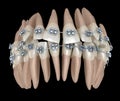 Abnormal teeth position and metal braces tretament. Medically accurate dental illustration