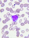 Abnormal white blood cells