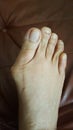 Abnormalities on the right foot Royalty Free Stock Photo