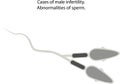 Abnormalities of sperm. Royalty Free Stock Photo