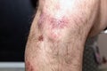 Abrasions on the foot of a man after a blow