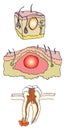 Abscess