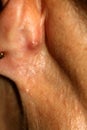 An abscess behind the ear. Inflamed red pimple