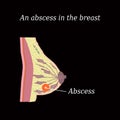 An abscess in the chest. The structure of the