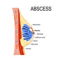 Abscess. Cross-section of the mammary gland with inflammation Royalty Free Stock Photo