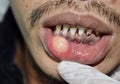Abscess or cyst with pus at lower lip