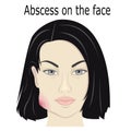 Abscess on the face