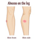 Abscess on the leg Royalty Free Stock Photo