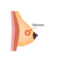 Abscess in the mammary gland. World Breast Cancer Day. Vector illustration on isolated background