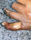 Abscess with surrounding cellulitis or Staphylococcal skin infection at little finger of left hand in Southeast Asian Burmese man.