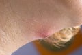 Abscess under the chin