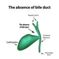 The absence of bile duct. Pathology of the gallbladder. Cholecystitis. Royalty Free Stock Photo