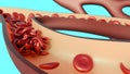AC blood vessel with a cluster of sickle cells obstructing the flow of blood.
