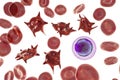 Acanthocytes, abnormal red blood cells with thorn-like projections