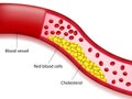 Accumulation of cholesterol in the arteries