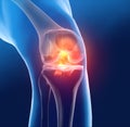 Painful knee joint with highlighted anterior and posterior cruciate ligament, medically 3D illustration