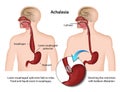 Achalasia of the esophagus 3d medical illustration