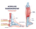 Achilles tendinopathy as injury to tendon in human heel outline diagram