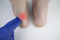 An orthopedic doctor examines a woman`s leg. Achilles tendon and ankle diseases. Inflammation of the heel and foot, Royalty Free Stock Photo