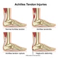 Achilles tendon injures medical vector illustration isolated on white background with english description Royalty Free Stock Photo