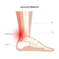 Achilles tendon injury Royalty Free Stock Photo