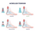 Achilles tendon injury types as leg or ankle trauma examples outline diagram Royalty Free Stock Photo