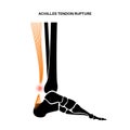 Achilles tendon injury Royalty Free Stock Photo
