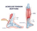 Achilles tendon rupture as painful injury and leg trauma outline diagram