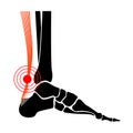 Achilles tendon injury