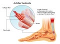 Achilles Tendonitis Royalty Free Stock Photo