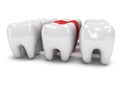 Aching tooth in row of healthy teeth Royalty Free Stock Photo