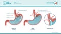 Acid reflux and heartburn infographic Royalty Free Stock Photo