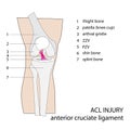 Acl knee injury Royalty Free Stock Photo