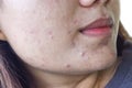 Acne , black spots and scars on face Royalty Free Stock Photo