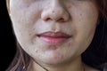 Acne, black spots and scars on face Royalty Free Stock Photo