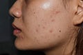 Acne , black spots and scars on face Royalty Free Stock Photo