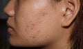 Acne , black spots and scars on face Royalty Free Stock Photo
