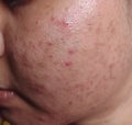 Acne, black spots and scars on the face Royalty Free Stock Photo