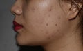 Acne , black spots and scars on face of Asian young woman Royalty Free Stock Photo