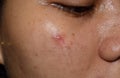 Acne , black spots and scars on face of Asian young woman Royalty Free Stock Photo